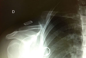 Único caso de seudoartrosis clavicular en nuestra serie.