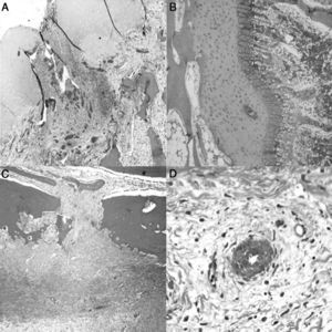 Histología a las 4semanas poscirugía. A)En el cartílago articular superficial aparecen pequeños focos de necrosis con reacción inflamatoria asociada (H&E, ×2). B)La fisis aparece ligeramente aumentada en relación con el animal control y con una zona más reducida de cartílago seriado (H&E, ×4). C)Marcada reacción perióstica con mayor actividad osteoclástica en el límite cortical con remodelación ósea. Puentes óseos entre la zona perióstica y endóstica que atraviesan la cortical del hueso (H&E, ×4). D)Asociada a la ligadura, se observa neovascularización; los vasos muestran engrosamiento de la pared por hiperplasia plexiforme externa (H&E, ×10).