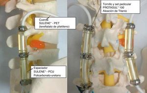 Sistema de estabilización dinámica Dynesys®.