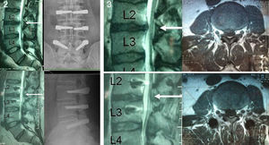 Paciente con enfermedad degenerativa discal Pfirrmann 3 y 4 en segmentos L2-L3-L4, estabilizada con Dynesys®. Véase la RM antes (arriba) y después (abajo) con reabsorción de pequeña protusión discal L2-L3 (flechas blancas).