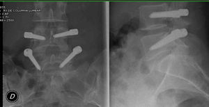 Tornillos L4 derecho con «Double halo sign» (línea radiotransparente rodeada de otra línea radiopaca de hueso de mayor densidad).