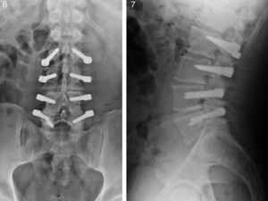 Rotura de tornillo L5 derecho del sistema de estabilización dinámica Dynesys®.