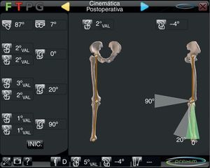 Pantalla del navegador en la que se recogen las variaciones del ángulo femorotibial tras implantar la prótesis de rodilla.