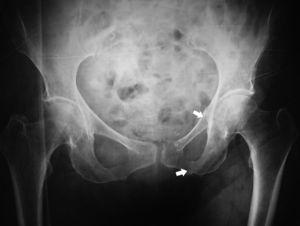 Radiografía anteroposterior de pelvis que muestra fracturas de rama ilio e isquiopubiana izquierdas.