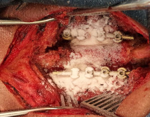 Imagen operatoria del aspecto del lecho quirúrgico tras la aplicación de vancomicina dentro de la herida quirúrgica de una instrumentación cervical vía posterior.