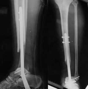 Radiografía anteroposterior y perfil mostrando la colocación postoperatoria del enclavado endomedular con el defecto óseo.