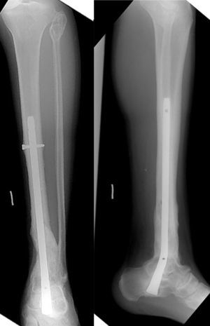 Radiografía anteroposterior y perfil mostrando la consolidación del defecto óseo a los 2 años de seguimiento.