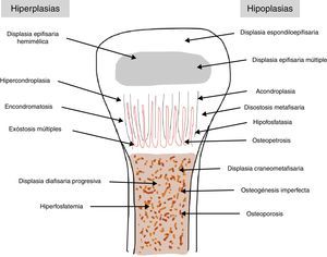 Clasificación de Rubin. Distingue las displasias óseas en función de la zona del hueso a la que afecta diferenciando si son hipo o hiperplasias.