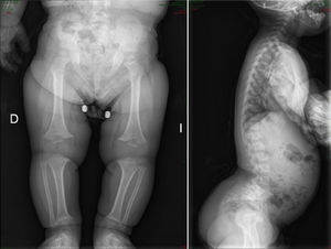 Hallazgos radiológicos típicos en acondroplasia: epífisis distal femoral con forma de «V» invertida, peroné de mayor longitud que tibia, horizontalización de sacro, hiperlordosis lumbar.
