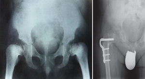 A la izquierda, radiografía AP de pelvis en la que se aprecian epífisis femorales irregulares con centros de osificación epifisaria múltiple, deformidades bilaterales en coxa vara. A la derecha, tratamiento de las deformidades mediante osteotomía valguizante y desrotadora.