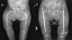 Paciente de 2 años afecta de OI intervenida por deformidades de ambos fémures mediante osteotomías de alineación y enclavado endomedular con clavo telescópico Fassier-Duval. En MII se introdujeron 2 AK para evitar la progresión distal del clavo.