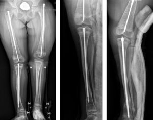 Niña de 7 años afecta de OI con enclavado telescópico de Fassier-Duval en ambos fémures y tibia derecha. Con el crecimiento, el clavo tibial ha provocado una fractura periimplante y se ha recambiado por otro más largo.