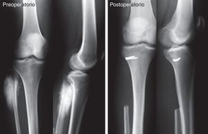 Caso clínico. Osteosarcoma de peroné proximal. Resección tipo II de Malawer y reconstrucción del complejo posterolateral de la rodilla a nivel de la metáfisis de la tibia con grapa.
