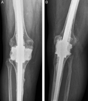 Resultado a 4 años de artrodesis de rodilla con clavo Endo-Model Link® e interposición de bloque de cemento. A) Anteroposterior. B) Lateral.
