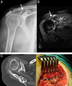A) Proyección anteroposterior de radiografía simple: fractura de la base del acromion (flecha) y acenso de la cabeza humeral. B) Resonancia magnética: rotura masiva del manguito rotador (flecha). C) Tomografía axial computarizada que demuestra una fractura desplazada de la espina de la escápula sin evidencia de consolidación (flecha). D) Fijación interna con una placa de reconstrucción.