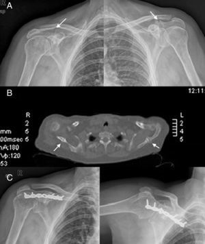 A) Proyección anteroposterior que demuestra fractura bilateral de la espina de la escápula (flechas). B) Tomografia axial computarizada: fractura bilateral sin evidencia de consolidación (flechas). C) Proyecciones anteroposterior y axilar que demuestran fijación interna con placa de reconstrucción.