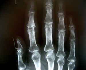 Proyección AP de artrosis IFP dedo índice.