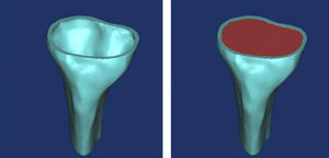Esquema 3D de los diferentes volúmenes óseos objeto del estudio. Definición de áreas objeto de estudio.