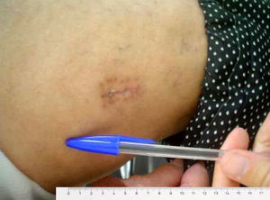 Imagen clínica de la cicatriz de una de las pacientes intervenidas mediante técnica MIDHS.