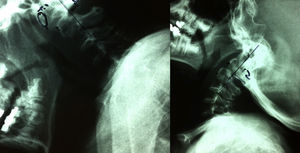 Radiografías dinámicas en flexión y extensión en las que se observa la inestabilidad cervical superior.
