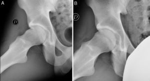 A) Proyección lateral de cadera (Dunn) con lesión tipo CAM en varón de 26 años. B) Proyección lateral de cadera (Dunn) con resultado postquirúrgico tras osteoplastia femoral.