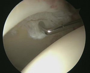 Visión artroscópica desde el portal anterolateral. Lesión del cartílago acetabular tipo «flap».