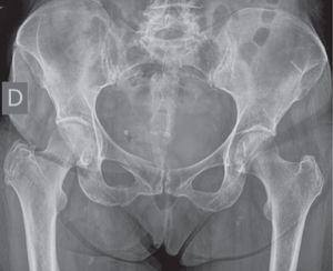 Imagen de radiología convencional en proyección anteroposterior.
