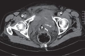Imagen de TAC abdominal donde se aprecia el hematoma.