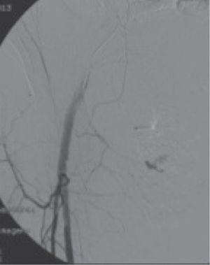 Imagen de arteriografía selectiva.
