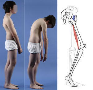 Varón de 16 años con espondilolistesis de alto grado. Esquema de la retroversión pélvica compensada con extensión de las caderas (limitada por el ligamento iliofemoral), flexión de rodillas y marcha de puntillas. El acortamiento de isquiotibiales dificulta la inclinación del tronco.