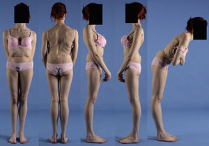 Mujer de 17 años con espondilolistesis de alto grado. Se observa el típico pliegue abdominal, la prominencia de los elementos posteriores de la vértebra listésica y la verticalización del sacro. Curva torácica derecha con desequilibrio coronal, y limitación de la flexión del tronco.