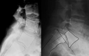 Diferencias radiológicas entre la espondilolistesis ístmica (izquierda) y displásica (derecha).