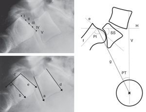 Mediciones radiológicas. Arriba, grado de deslizamiento de Meyerding. Abajo, líneas de referencia para medir el ángulo lumbosacro según Boxall (a, b), Dubousset (c, d) y Wiltse (a, e). A la derecha, incidencia pélvica (PI), rotación o inclinación pélvica (PT) y pendiente sacra (SS). a: platillo inferior de L5; b: línea perpendicular a c (borde posterior del sacro); d: platillo superior de L5; e: platillo superior del sacro; f: perpendicular a e; g: línea que une el centro de e con el centro de la cabeza femoral (o la mitad de la distancia entre el centro de ambas cabezas femorales); H: horizontal; V: vertical.
