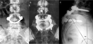 a) Reparación de la pars con «Smiling face». b) Artrodesis instrumentada posterior in situ. c) Transfijación lumbosacra.