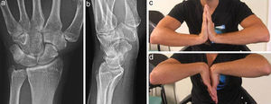 Radiografía simple AP y lateral (a y b), y flexo-extensión de muñeca (c y d) un año tras la lesión.