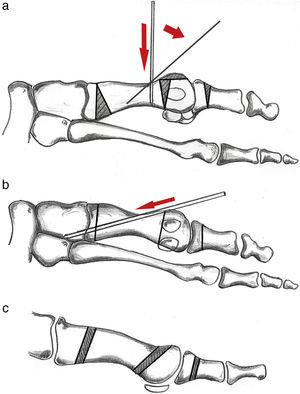 Técnica quirúrgica de la doble osteotomía percutánea. a) Introducción de la aguja de Kirschner y maniobra para el cierre de la osteotomía. b) Fijación de la aguja a la primera cuña. c) Vista lateral de la doble osteotomía y la osteotomía de Akin.