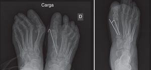 Doble osteotomía con corrección del DMAA (PASA) y osteotomía de la base fijada con una aguja de Kirschner (izquierda) y con dos agujas (derecha), en ambos casos se asociaron osteotomías tipo Weil de los metatarsianos menores).