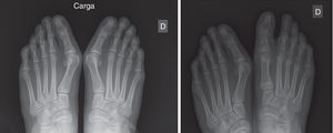 Radiografías comparativas en paciente de 20 años de edad intervenida mediante la técnica descrita con excelentes resultados.