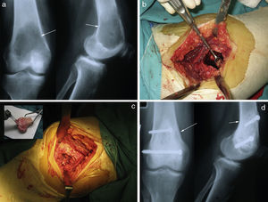 Composición de un TCGO de fémur distal. a) Obsérvense imágenes de radiografía simple anteroposterior y lateral mostrando una lesión lítica metafisoepifisaria de cóndilo femoral interno, excéntrica que adelgaza la cortical sin romperla, con márgenes mal definidos, sin reacción perióstica. b) Tratamiento mediante resección intralesional por legrado agresivo y fresado a alta velocidad. c) Aporte de injerto esponjoso homólogo fragmentado y estructural corticoesponjoso en marquetería, fijado con tornillos. d) Control evolutivo mediante radiografías simples donde se observa la correcta integración del injerto.