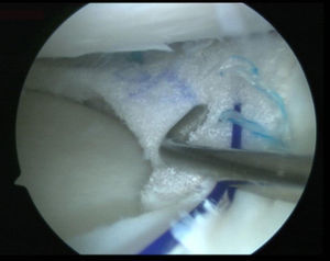 Visión artroscópica desde el portal anterolateral del implante de poliuretano suturado al tejido meniscal medial remanente en la rodilla derecha.