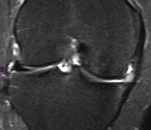 Imagen coronal potenciada en T2 coronal a los dos años del implante fracasado. El tamaño del implante es de tipo 2 y la intensidad de la señal es de tipo 1. La imagen muestra la extrusión del implante y cambios degenerativos en el compartimento medial.