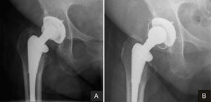 A. Radiografía preoperatoria en la que se observa el desgaste del polietileno y una lesión osteolítica periacetabular. B. Radiografía al final del seguimiento donde se evidencia la resolución de la lesión osteolítica.