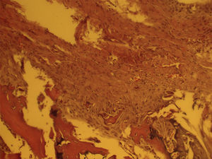 Corte histológico (hematoxilina-eosina, x40) de la entesis con 4 semanas de evolución. La entesis aparece altamente celular y muy desorganizada.