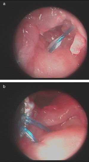 a y b. Imágenes artroscópicas de la técnica quirúrgica. Paso del hilo monofilamento 3/0 a través del fibrocartílago desgarrado según la técnica fuera-dentro.