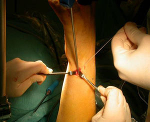 Colocación del implante en su localización foveal, reinsertando en dicho punto el FCT lesionado.