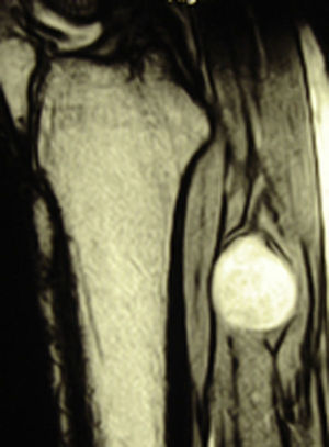 RMN que muestra lesión redondeada próxima al tibial posterior.