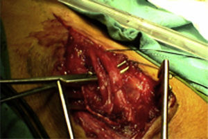 Neurinoma del ciático poplíteo externo después de la intervención.