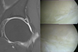 Varón de 45 años. En la imagen de la izquierda se observan, en un corte coronal, delaminación del cartílago acetabular y un quiste sublabral. Las imágenes de la derecha son fotos intraoperatorias que muestran la lesión condral vista en la artro-RM.