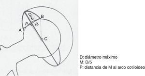 Medición del ángulo de anteversión según el método de Riten Pradhan.