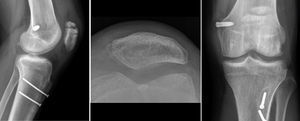 Paciente del grupo de aloinjerto con fractura no desplazada de polo proximal en relación a túnel transpatelar proximal resuelta con tratamiento conservador.